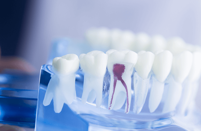 best clinic for root canal and teeth whitening in andheri.png
