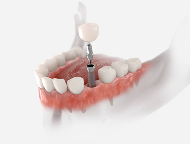 best dentist for dental implants in andheri